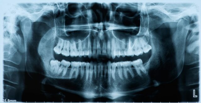 Full mouth x-ray image
