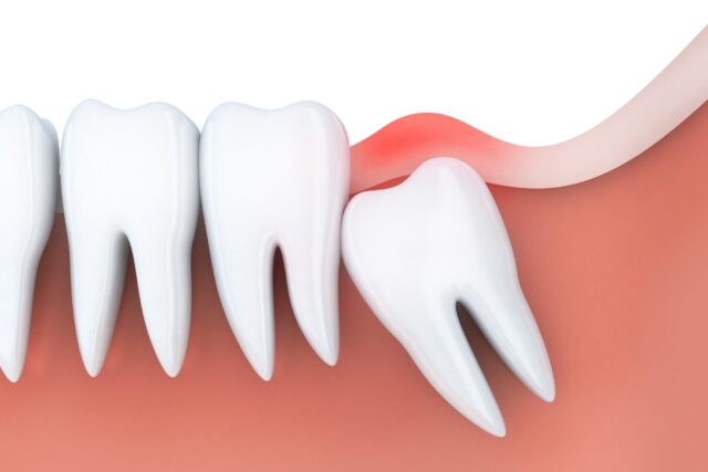 A side profile of what it looks like when a Wisdom tooth is impacting the tooth next to it, necessitating a wisdom tooth extraction
