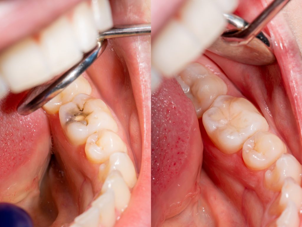 a person has a cavity filled with composite fillings at summit family and cosmetic dentistry