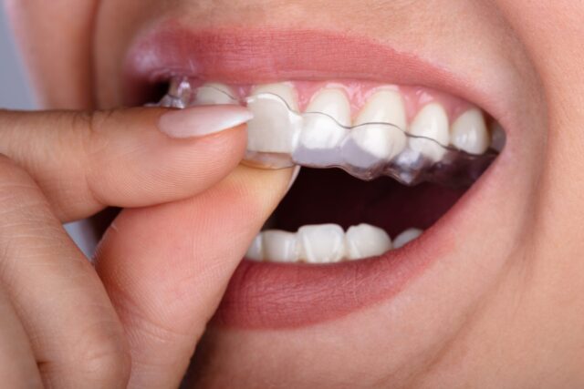 woman putting in new clear aligners from summit family and cosmetic dentistry
