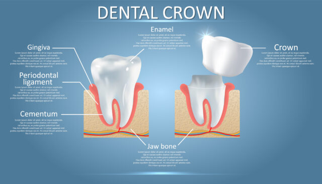Illustration of dental crown installation