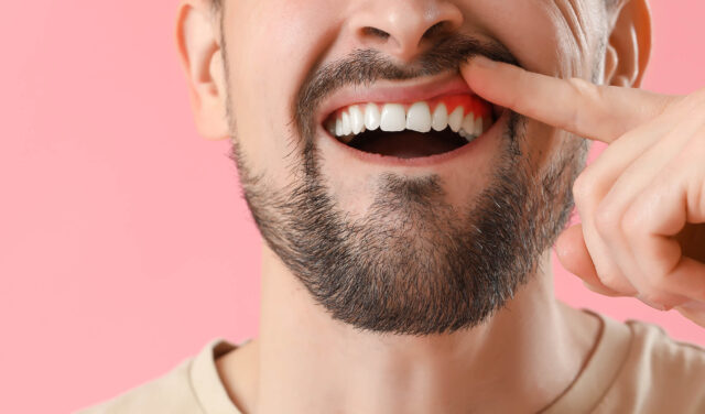 man with inflamed gums