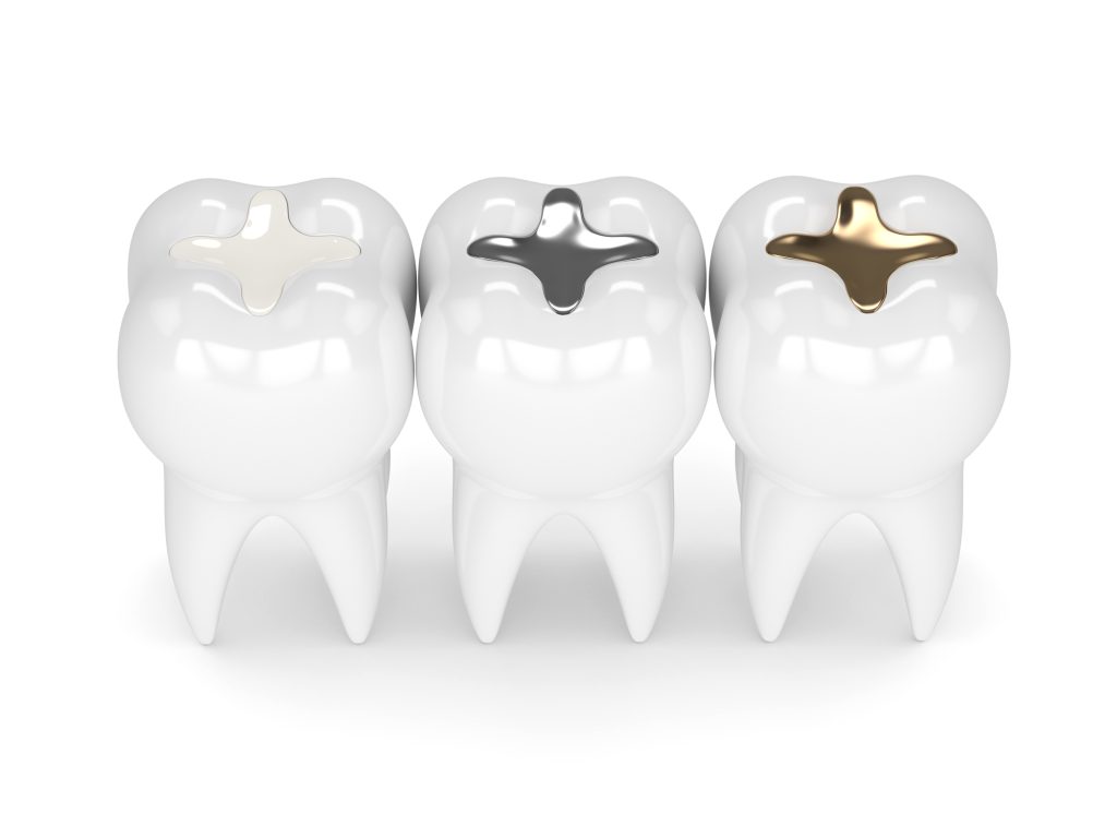 illustration comparing amalgam and composite fillings