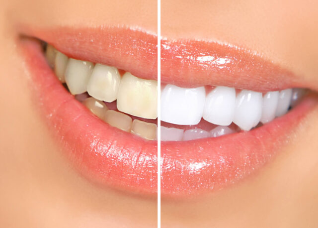 before and after of a woman after teeth whitening