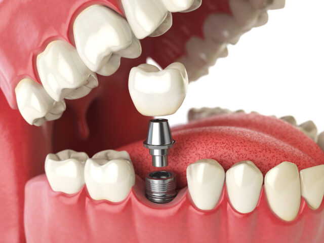 Illustration of dental implant surgery