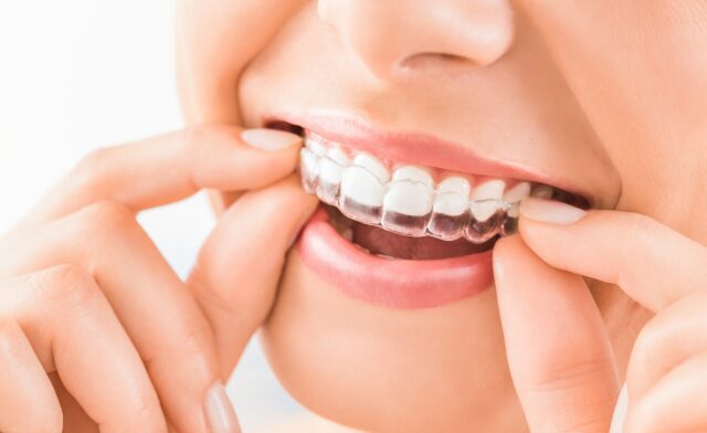 girl installing Invisalign