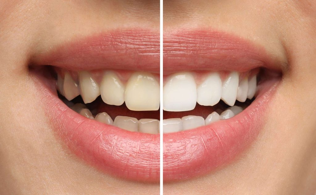 Before and After Teeth Whitening
