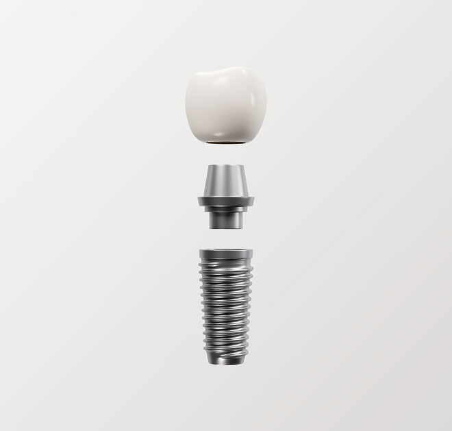 dental implant in Spokane