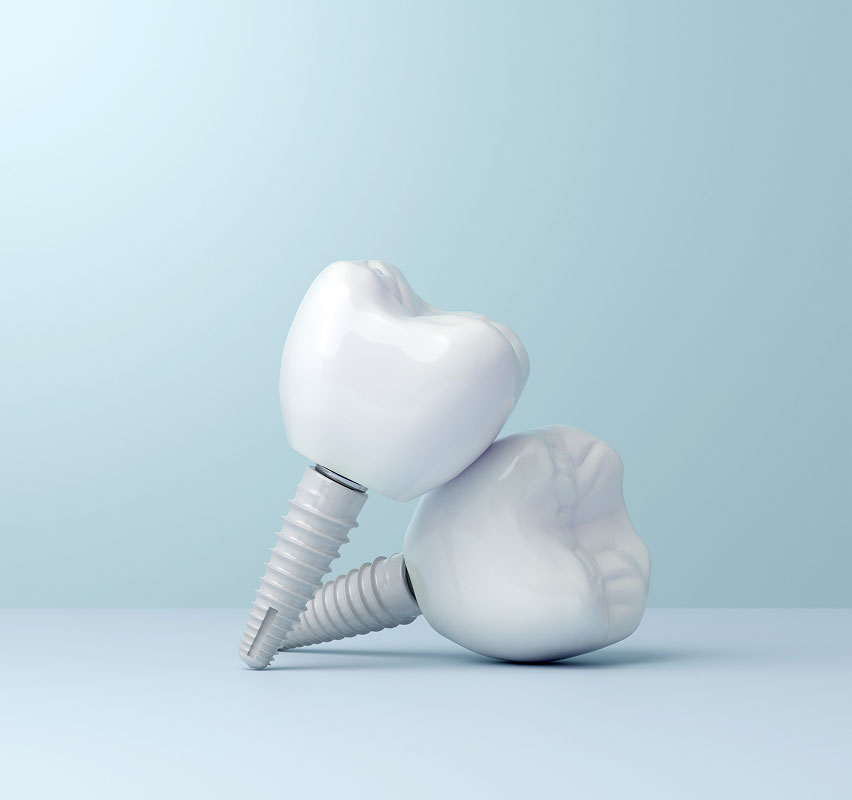 dental implants