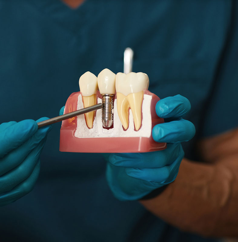 dental implants in Spokane, WA