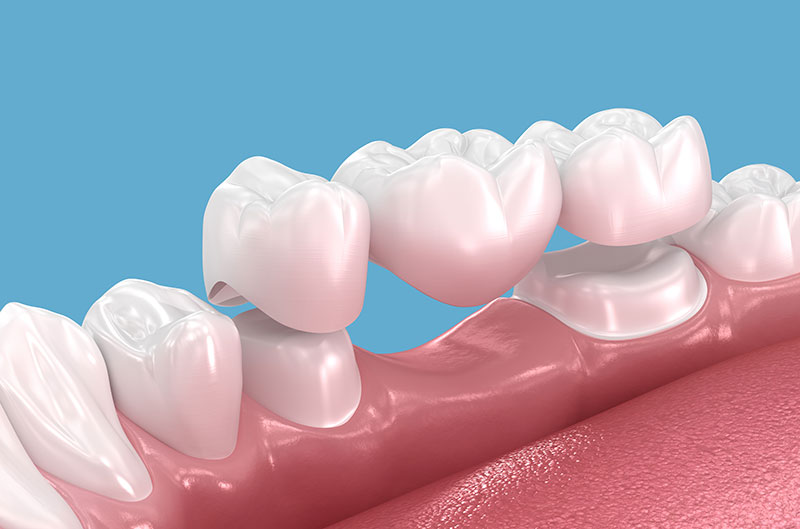 dental bridges and crowns in Spokane, WA