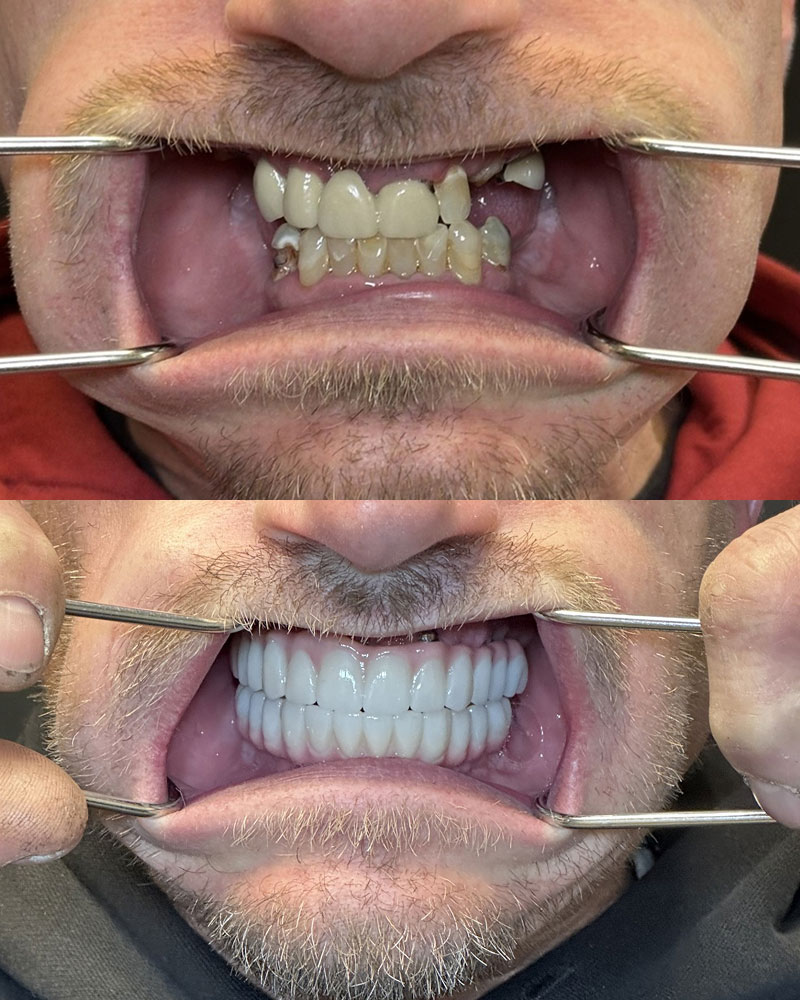 before and after dentures at Summit Family & Cosmetic Dentistry