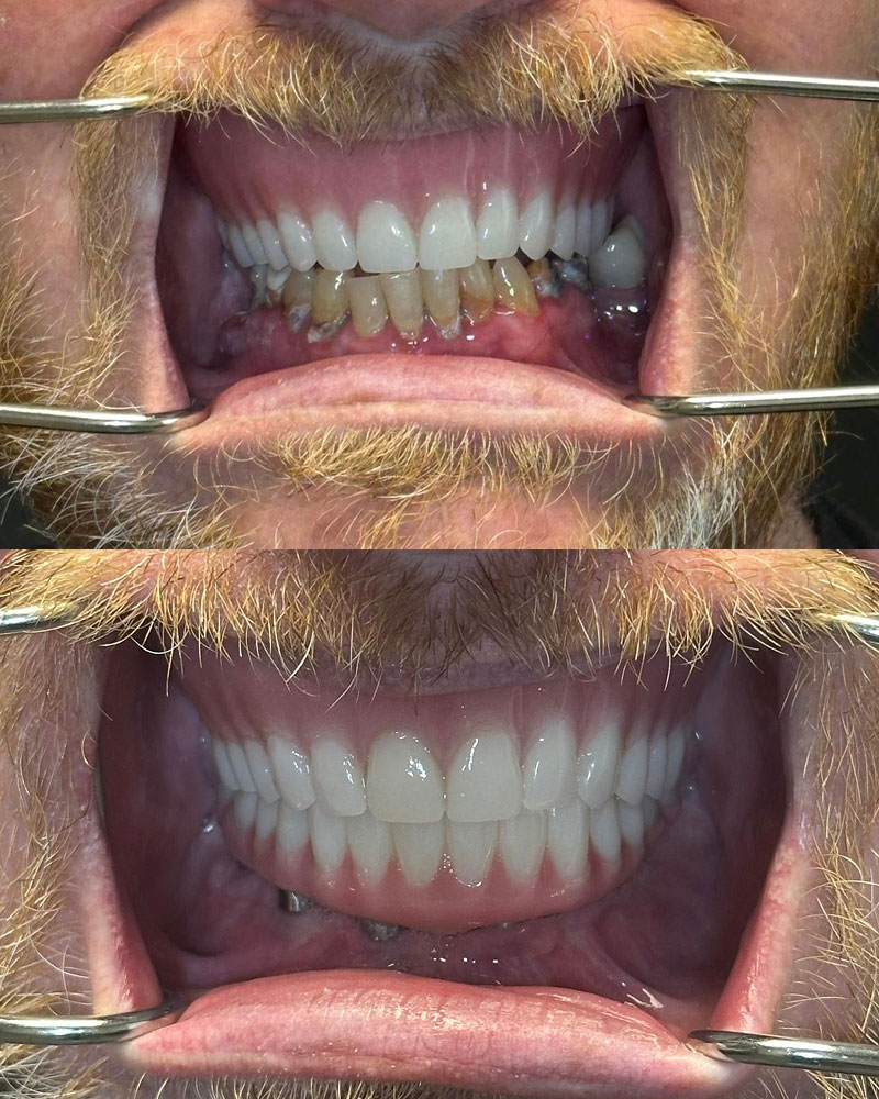 before and after dentures at Summit Family & Cosmetic Dentistry