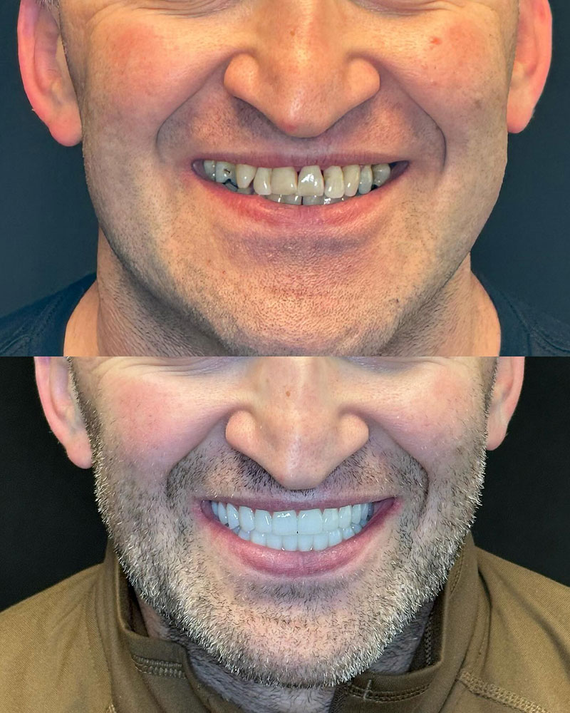 before and after dentures at Summit Family & Cosmetic Dentistry