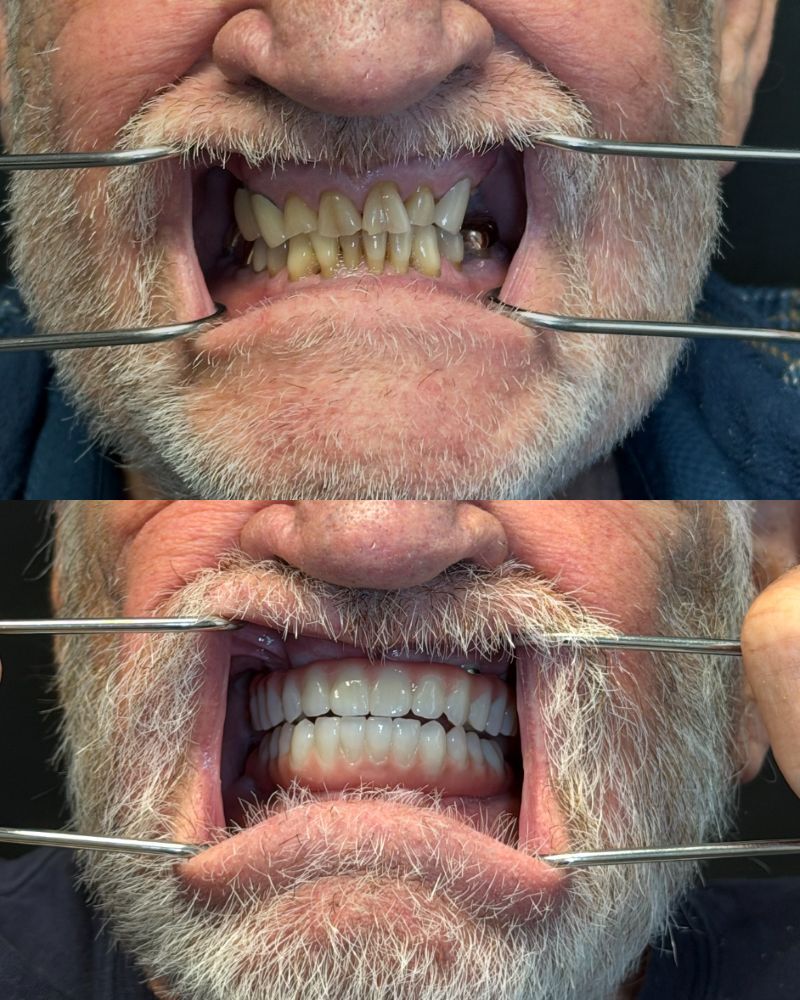 AllOnXBeforeAfter_Summit